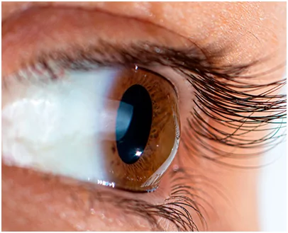 Ceratocone e Transplante de Cornea