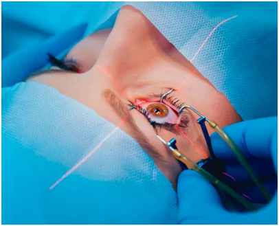 Cirurgia Refrativa